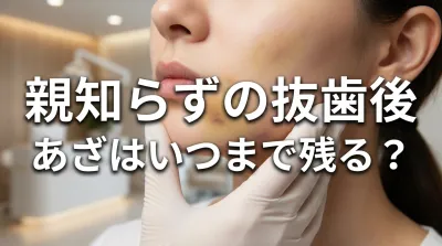 親知らずの抜歯後あざはいつまで残る？